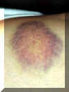 web_Kates_bruise.jpg (213450 bytes)